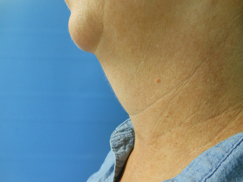 Side view of a person's neck with light wrinkles against a blue background