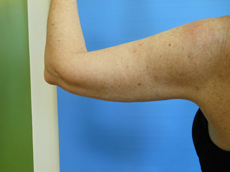 Close-up of a bare arm raised against a blue background. Skin shows freckles and light texture