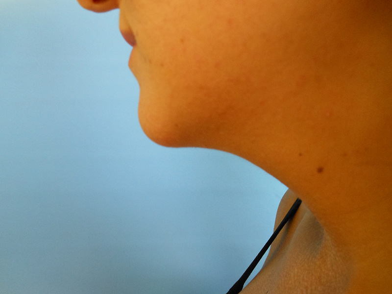 Profile view of a person's chin and neck against a blue background