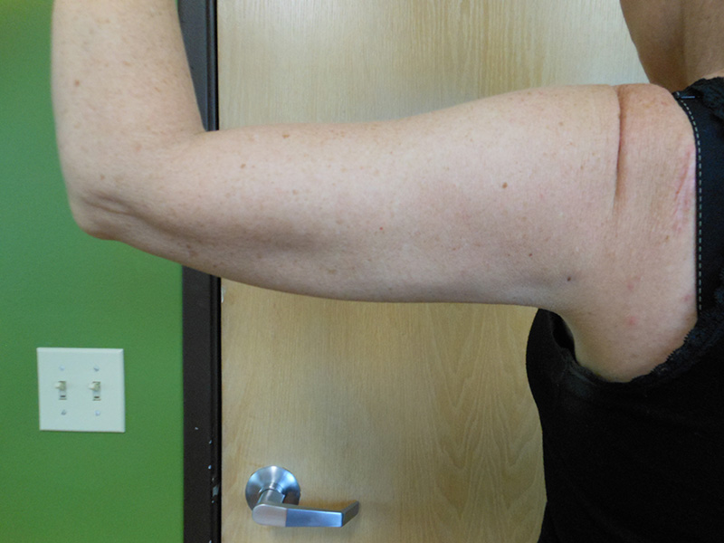 A close-up of a person's raised arm showing the underside with a scar