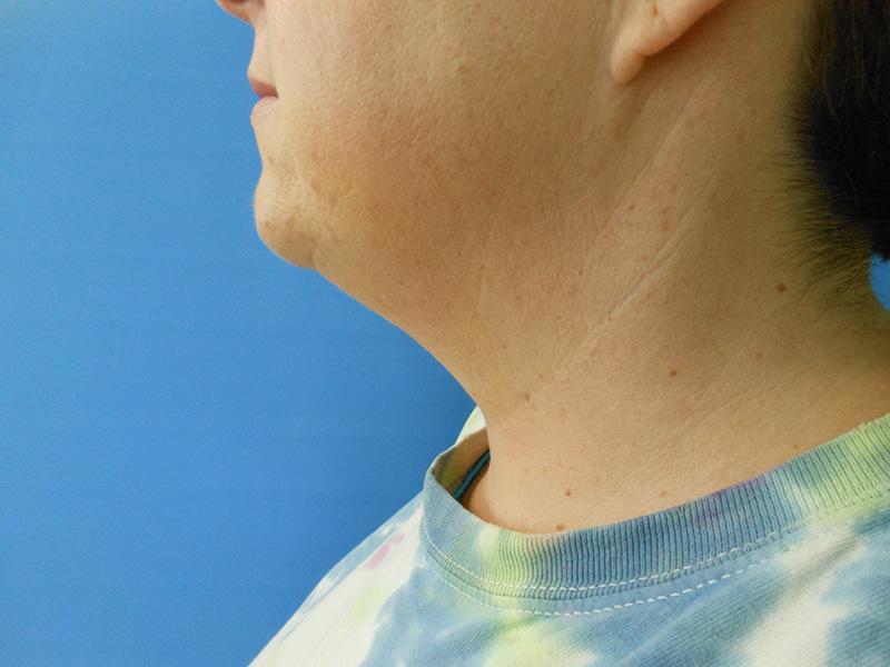 Profile view of a person’s neck and chin, against a blue background