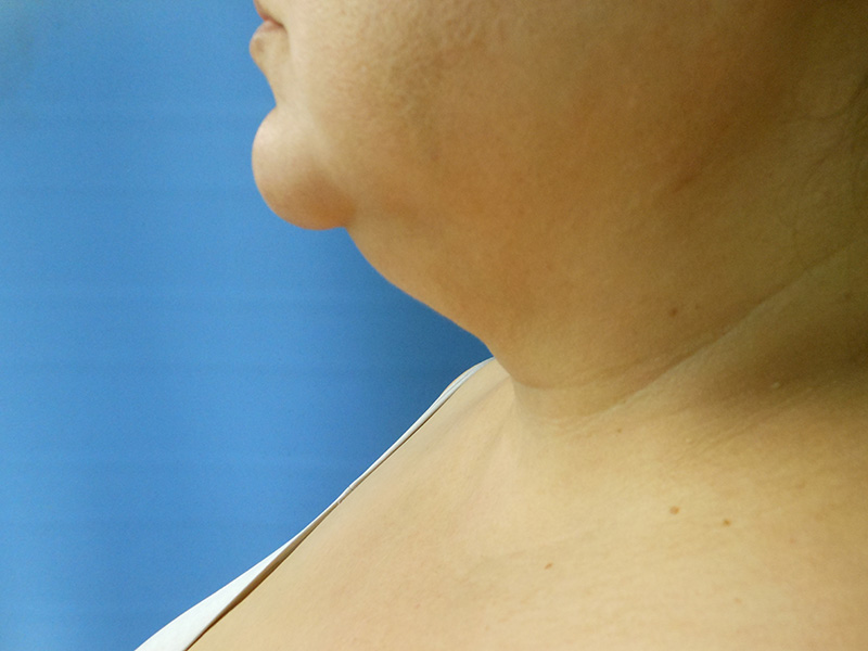 Profile view of a person's neck and chin against a blue background