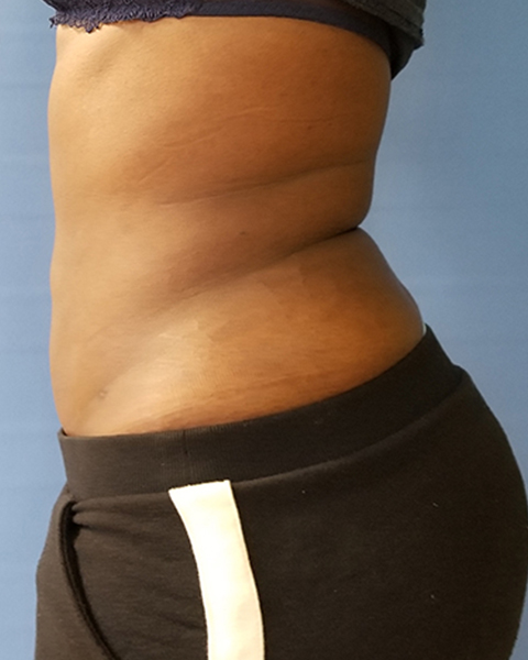 Side view of a torso showing skin texture and the waistline in dark clothing