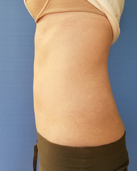Side view of a bare torso showing skin and visible stretch marks, against a blue background