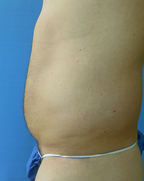 Side view of a torso with a slight bulge, wearing blue shorts against a blue background