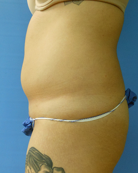 Side view of a person's abdomen, showing skin with stretch marks and a waistband