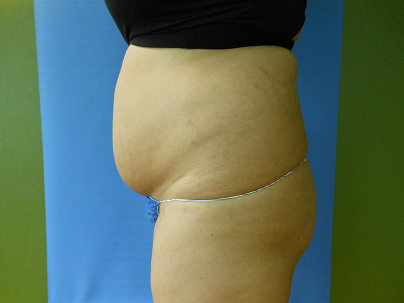 Side view of a torso with a protruding abdomen and stretch marks, against a colored background