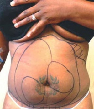 A torso with a tattoo and markings on the skin, hand resting on the stomach