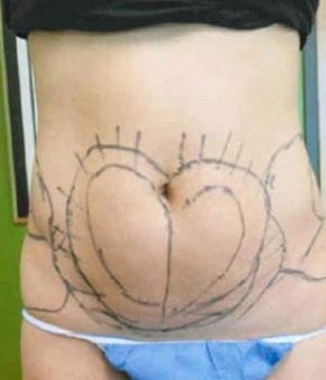 A bare abdomen with a heart shape drawn in ink and faint lines around it
