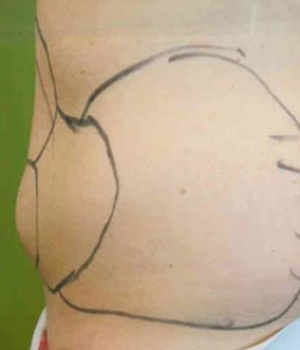 Side view of a person's torso with black lines drawn on the skin