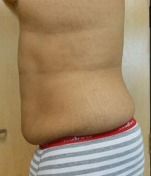Side view of a person's torso showing skin and stretch marks above elastic waistband