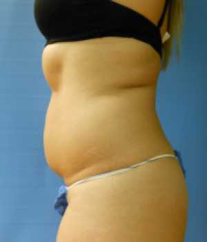 Side view of a person’s torso showing a slight abdomen with a black top and blue underwear