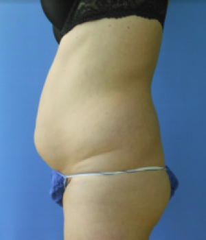 Side view of a person's torso showing a rounded abdomen and wearing minimal clothing