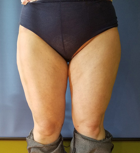 Person standing in high-waisted underwear, with pants around ankles, facing forward