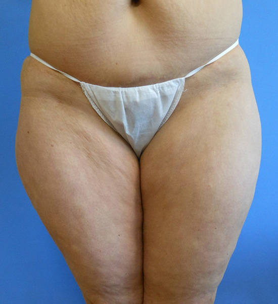 Photo of a person's lower body, wearing white underwear, with visible skin texture