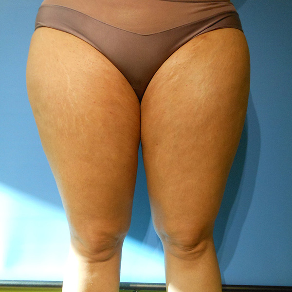 Person's lower body wearing brown swimwear, featuring visible skin texture and marks
