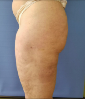 Side view of a thigh with visible skin texture and discoloration against a blue background