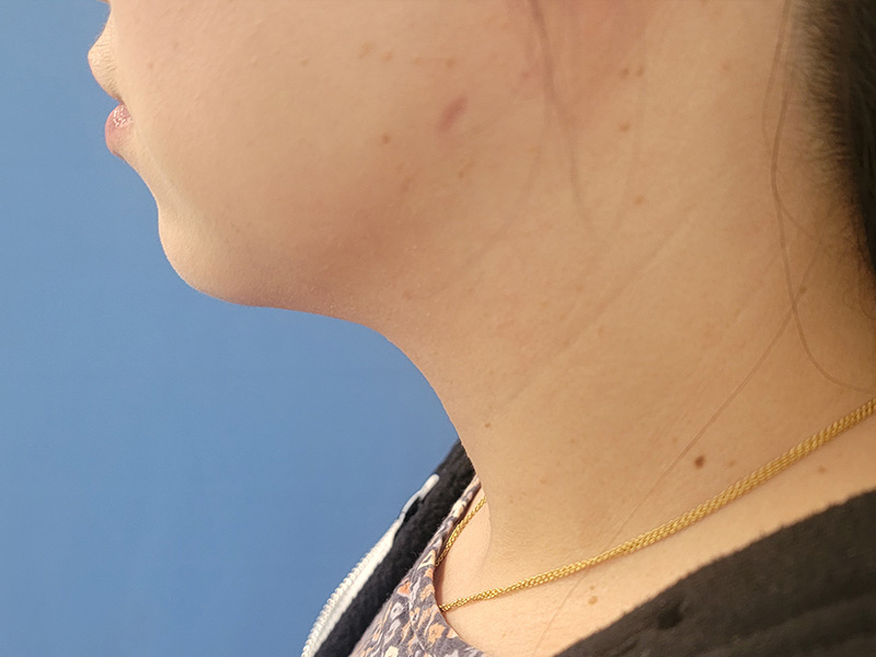 Profile view of a person's face and neck against a blue background
