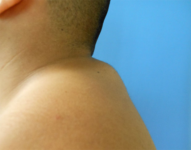 Close-up of a person's shoulder and neck against a blue background